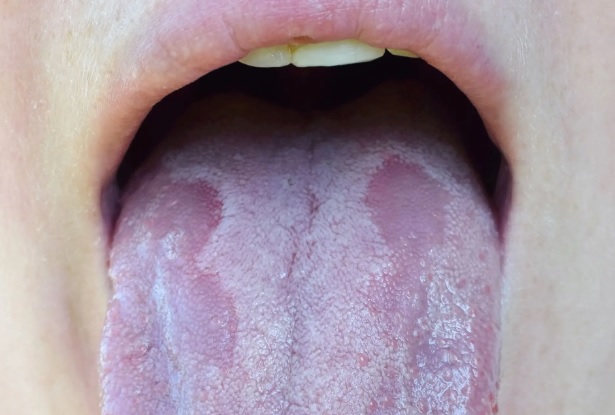 Jakie choroby mogą ukrywać się za pleśniawkami jamy ustnej?