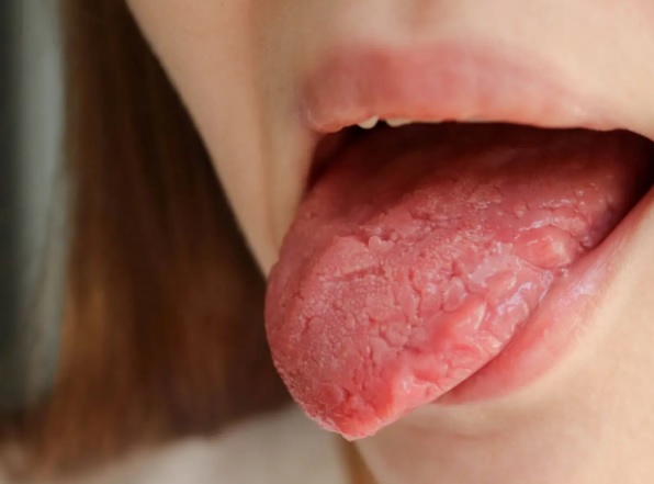 Czy pleśniawki mogą rozprzestrzeniać się poza jamę ustną?